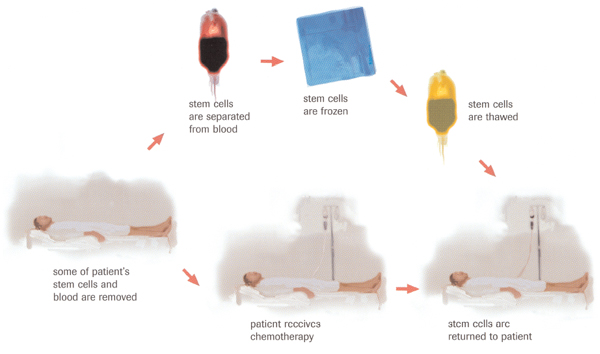 Autologous transplant Autologous transplant